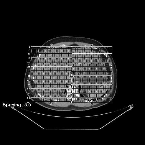 Acute complicated calculous cholecystitis (Radiopaedia 55202-61587 Coronal C+ portal venous phase 1).jpg