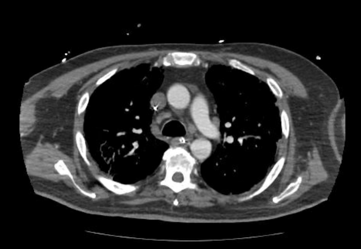 Acute cor pulmonale (ultrasound) (Radiopaedia 83508-98818 Axial C+ CTPA 25).jpg