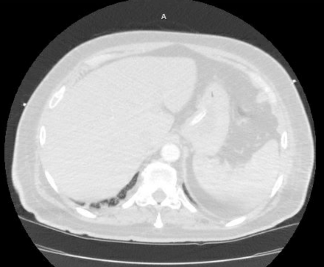 Acute cor pulmonale (ultrasound) (Radiopaedia 83508-98818 Axial lung window 86).jpg