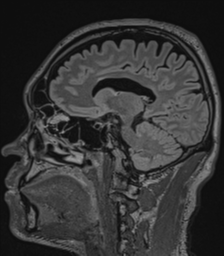 Acute disseminated encephalomyelitis (ADEM)- Anti-NMDA receptor encephalitis (Radiopaedia 54920-61201 Sagittal FLAIR 38).png