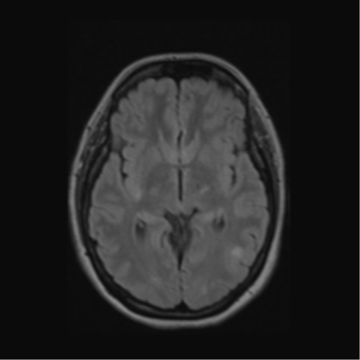 Acute disseminated encephalomyelitis (ADEM) (Radiopaedia 38073-40065 Axial FLAIR 29).png