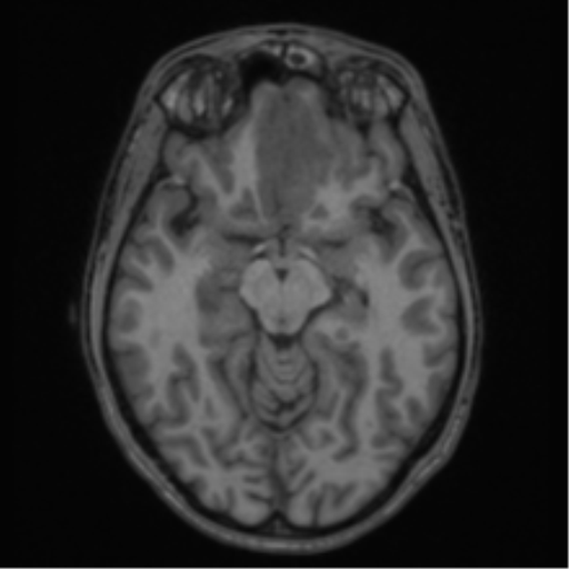 Acute disseminated encephalomyelitis (ADEM) (Radiopaedia 65319-74349 Axial T1 25).png