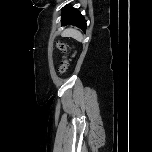 Acute diverticulitis - transverse colon (Radiopaedia 87063-103327 Sagittal C+ portal venous phase 185).jpg
