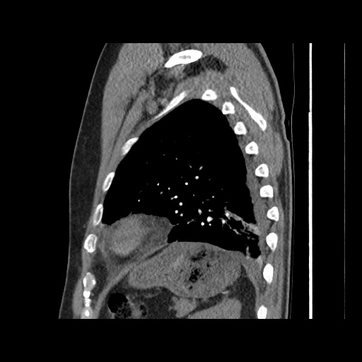 Acute epicardial fat necrosis (Radiopaedia 42327-45440 Sagittal C+ CTPA 55).jpg