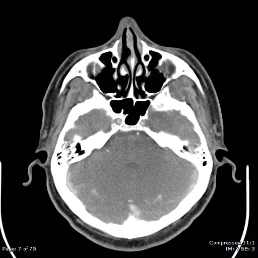 File:Acute epiglottitis (Radiopaedia 54375-60590 Axial 63).jpg
