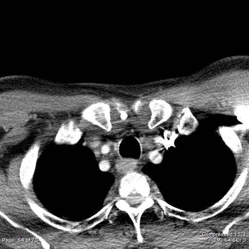 File:Acute epiglottitis (Radiopaedia 54375-60590 Axial C+ arterial phase 64).jpg