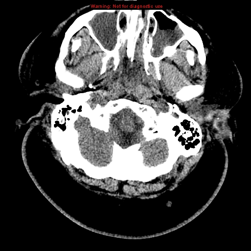Acute hemorrhagic leukoencephalitis (Radiopaedia 14076-43697 Axial non-contrast 3).jpg