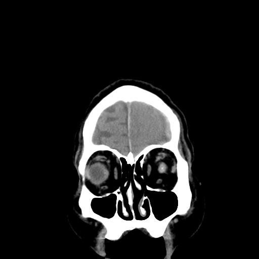 Acute hemorrhagic stroke (Radiopaedia 17507-17223 Coronal non-contrast 5).jpg