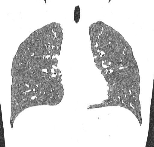 Acute hypersensitivity pneumonitis (Radiopaedia 85293-100870 Coronal lung window 56).jpg