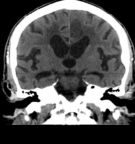 Acute left anterior cerebral artery territory infarction (Radiopaedia 51785-57578 Coronal non-contrast 31).jpg