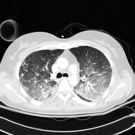 Acute myocardial infarction in CT (Radiopaedia 39947-42415 Axial lung window 43).jpg