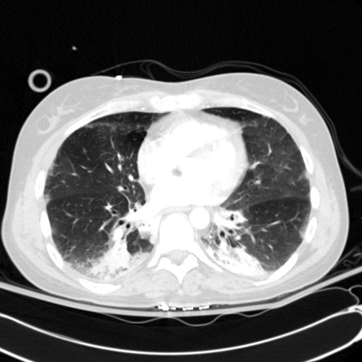 File:Acute myocardial infarction in CT (Radiopaedia 39947-42415 Axial lung window 79).jpg