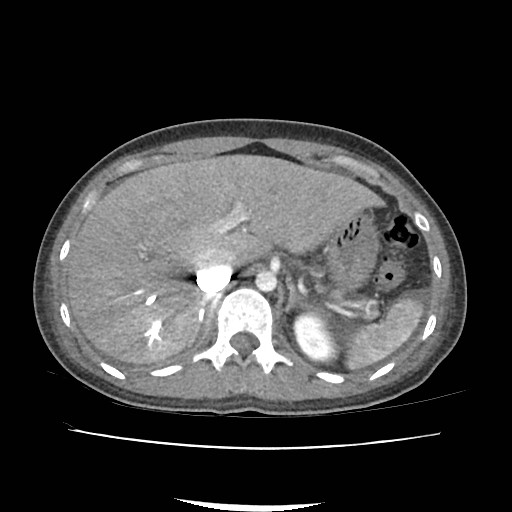File:Acute myocarditis (Radiopaedia 55988-62613 Axial C+ portal venous phase 19).jpg