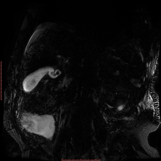 File:Acute necrotizing pancreatitis (Radiopaedia 28194-28448 Coronal MRCP 23).jpg