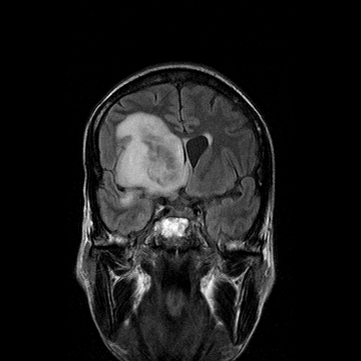File:Acute necrotizing toxoplasma encephalitis (Radiopaedia 10683-11149 Coronal FLAIR 13).jpg