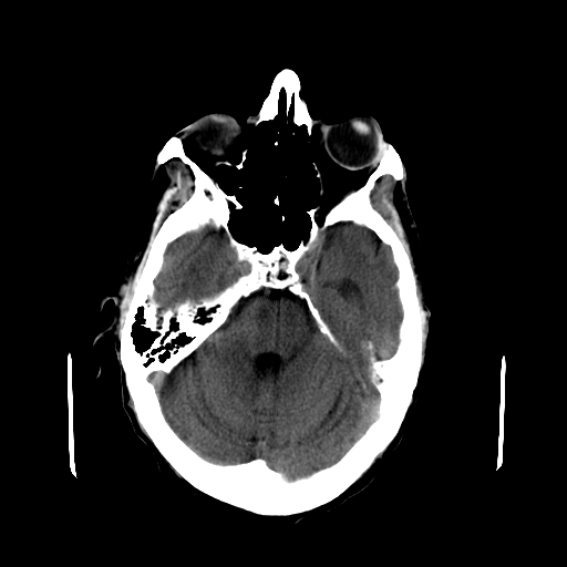 File:Acute necrotizing toxoplasma encephalitis (Radiopaedia 10683-11150 B 23).jpg
