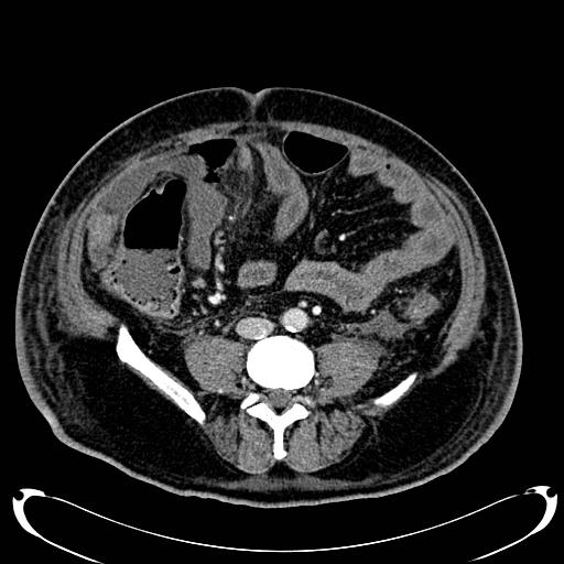 Acute pancreatic necrosis (Radiopaedia 13560-18500 Axial C+ portal venous phase 101).jpg