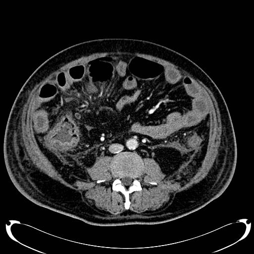 Acute pancreatic necrosis (Radiopaedia 13560-18500 Axial C+ portal venous phase 92).jpg