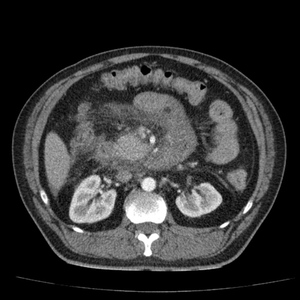 Acute pancreatitis (Radiopaedia 26663-26813 Axial C+ arterial phase 43).jpg