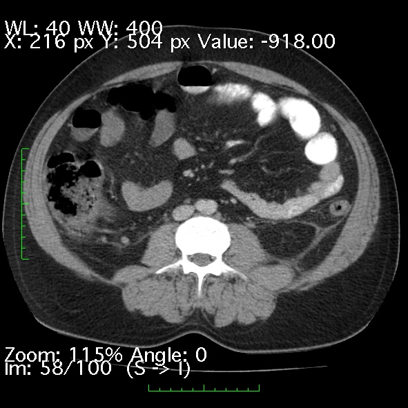 Acute pancreatitis (Radiopaedia 34043-35276 Axial C+ portal venous phase 58).jpg
