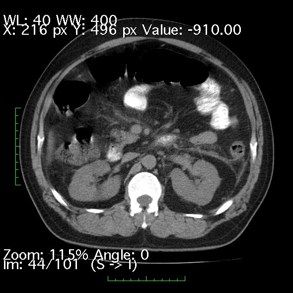 File:Acute pancreatitis (Radiopaedia 34043-35276 Axial non-contrast 44).jpg
