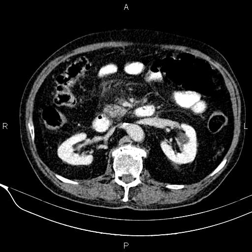 Acute pancreatitis (Radiopaedia 85146-100701 Axial C+ portal venous phase 30).jpg