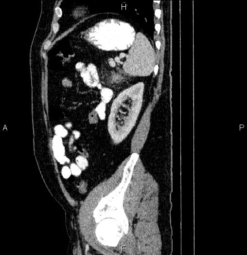 Acute pancreatitis (Radiopaedia 85390-101010 Sagittal C+ portal venous phase 81).jpg