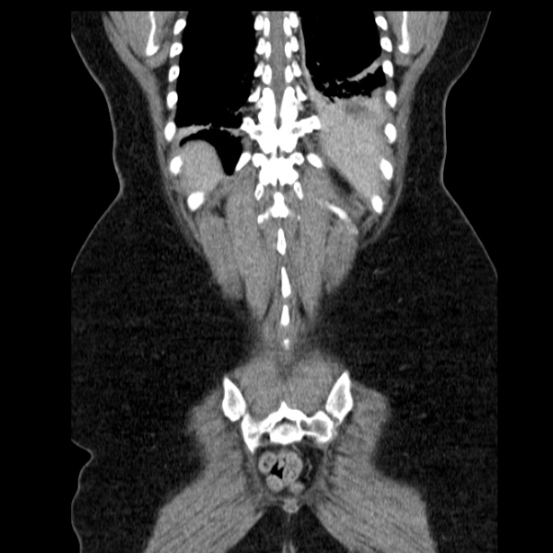 Acute pancreatitis - Balthazar C (Radiopaedia 26569-26714 Coronal C+ portal venous phase 58).jpg
