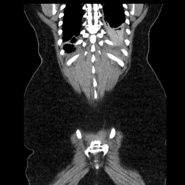 Acute pancreatitis - Balthazar C (Radiopaedia 26569-26714 Coronal C+ portal venous phase 60).jpg
