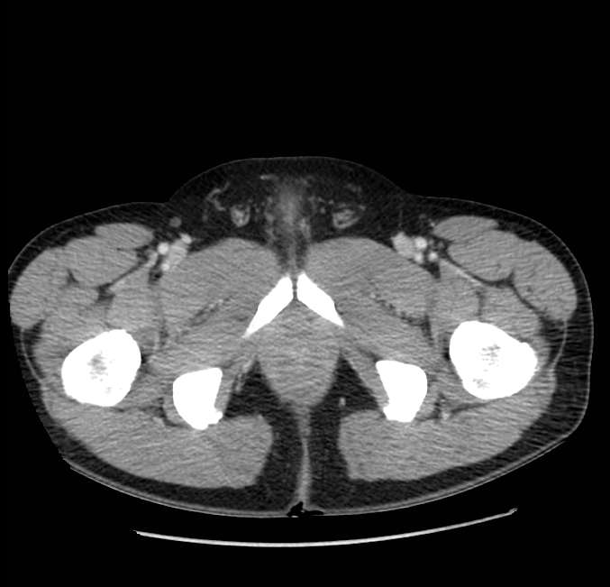 Acute pancreatitis - Balthazar E (Radiopaedia 23080-23110 Axial C+ portal venous phase 78).jpg
