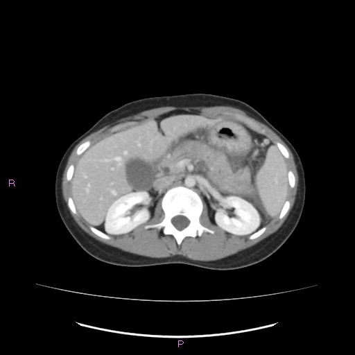 Acute pancreatitis secondary to stone at minor papilla and pancreatic divisum (Radiopaedia 76570-88333 Axial C+ portal venous phase 27).jpg