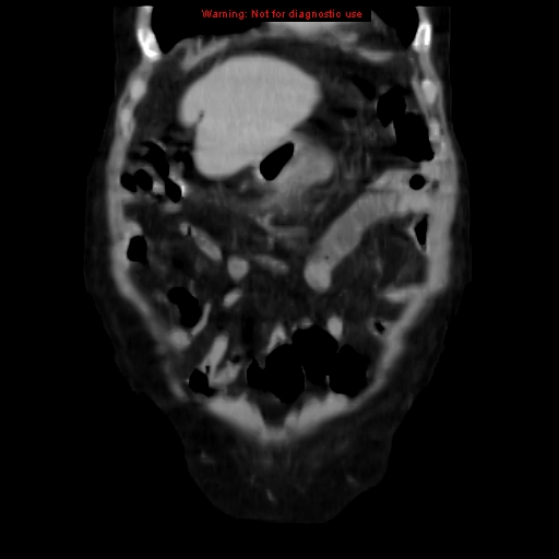 Acute pancreatitis with incidental pancreatic lipoma (Radiopaedia 10190-10730 Coronal C+ portal venous phase 13).jpg