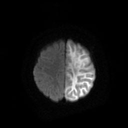 File:Acute phase of hemiconvulsion-hemiplegia epilepsy syndrome (Radiopaedia 29309-29745 Axial DWI 18).jpg