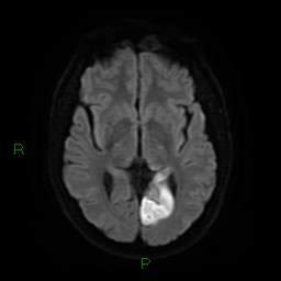 File:Acute posterior cerebral artery territory infarct (Radiopaedia 79329-92394 Axial DWI 14).jpg