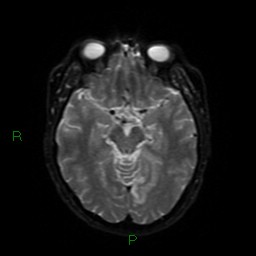 Acute posterior cerebral artery territory infarct (Radiopaedia 79329-92394 Axial DWI 40).jpg