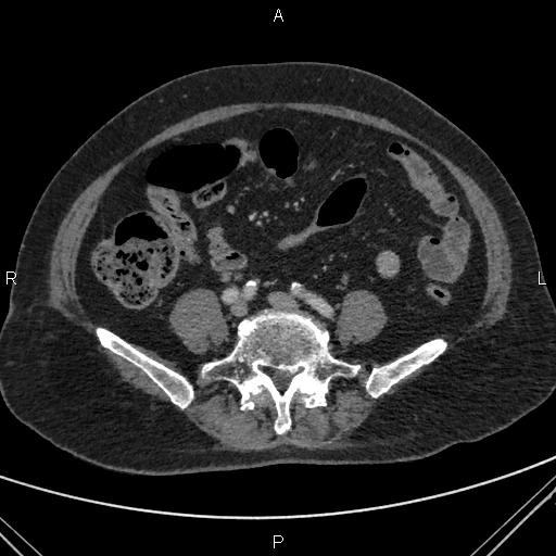 File:Acute renal artery occlusion (Radiopaedia 86586-102682 Axial C+ portal venous phase 63).jpg