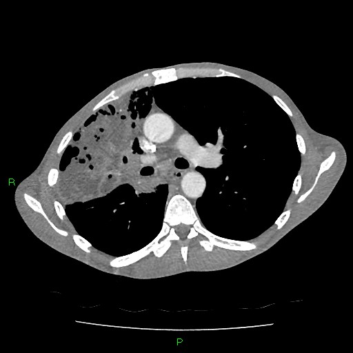 File:Acute right lung abscess (Radiopaedia 34806-36258 Axial C+ arterial phase 77).jpg