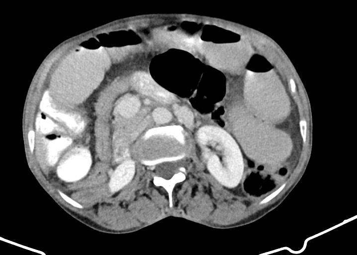 Acute small bowel (ileal) volvulus (Radiopaedia 71740-82139 Axial C+ portal venous phase 89).jpg