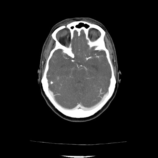 File:Acute subarachnoid hemorrhage and accessory anterior cerebral artery (Radiopaedia 69231-79009 Axial C+ arterial phase 90).jpg