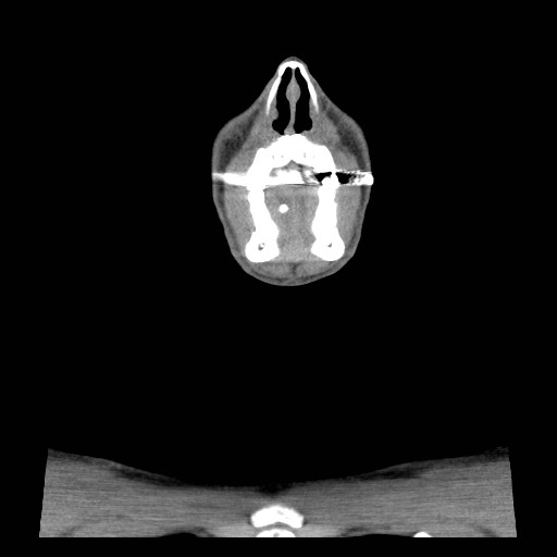 File:Acute submandibular sialadenitis secondary to ductal stone (Radiopaedia 27999-28267 Coronal C+ delayed 1).jpg