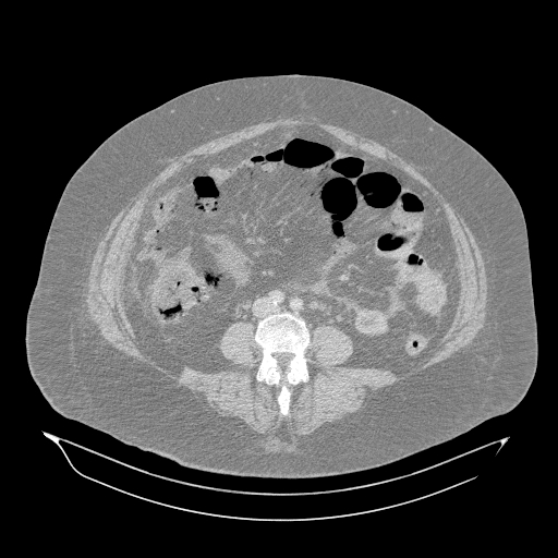 File:Acute superior mesenteric artery occlusion (Radiopaedia 51288-56960 Axial lung window 38).jpg