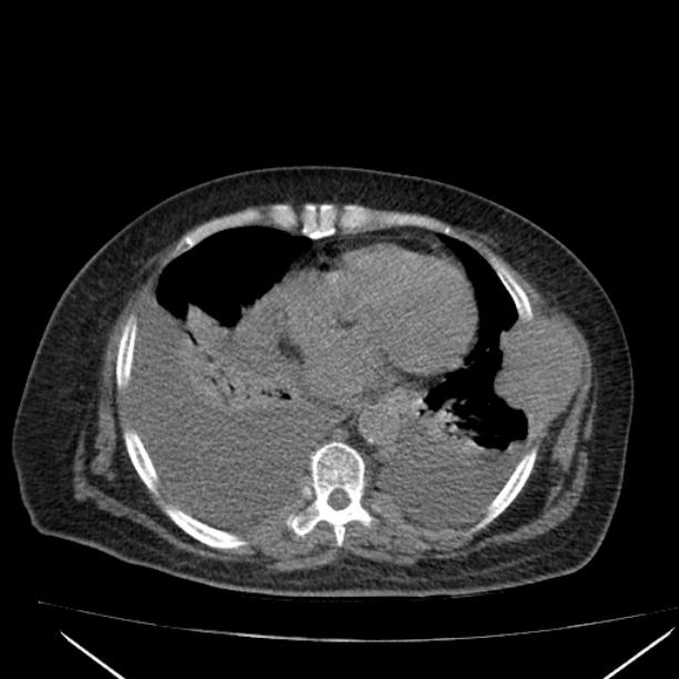 Acute tubular necrosis (Radiopaedia 28077-28334 Axial non-contrast 4).jpg