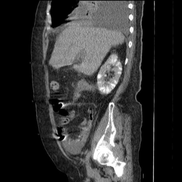 Acute tubular necrosis (Radiopaedia 28077-28334 Sagittal non-contrast 29).jpg