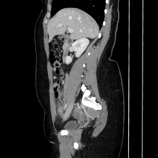 Acute uncomplicated appendicitis (Radiopaedia 73704-84499 Sagittal C+ portal venous phase 91).jpg