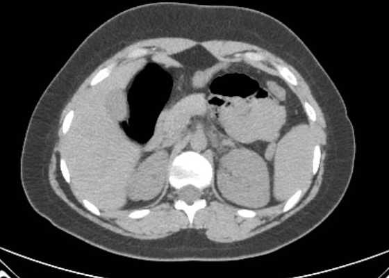 Acute unilateral nonhemorrhagic adrenal infarction (Radiopaedia 67560-76957 Axial non-contrast 43).jpg