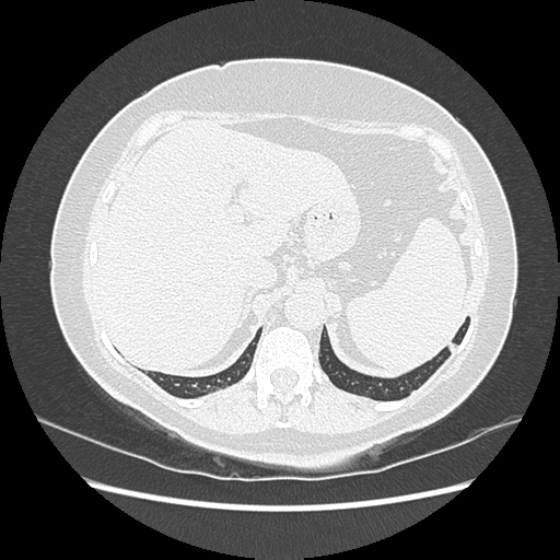 Adenocarcinoma in situ of lung (Radiopaedia 38685-40829 B 206).png