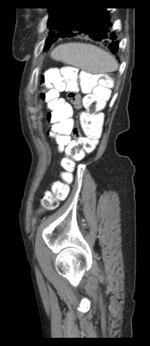 Adenocarcinoma of cecum (Radiopaedia 59222-66549 Sagittal C+ portal venous phase 5).jpg