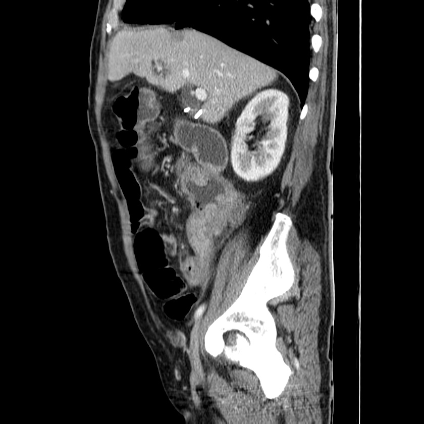 Adenocarcinoma of colon with entero-colic fistula (Radiopaedia 22832-22852 Sagittal C+ portal venous phase 21).jpg