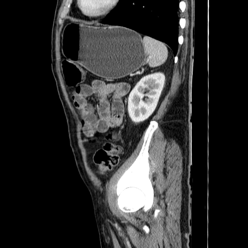 Adenocarcinoma of colon with entero-colic fistula (Radiopaedia 22832-22852 Sagittal C+ portal venous phase 50).jpg