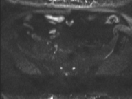 Adenocarcioma of rectum- T1 lesion (Radiopaedia 36921-38546 Axial DWI 27).png